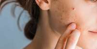Saiba como não errar no tratamento para acne  Foto: Shutterstock / Alto Astral