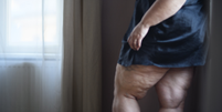 Lipedema  Foto: Sou Mais Bem Estar