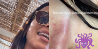 Anitta relata ter sofrido ataque de água-viva durante passeio em Ibiza  Foto: Reprodução/Instagram/@anitta