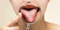 Saburra lingual é resultado do acúmulo de placa bacteriana na língua Foto: Shutterstock / Alto Astral