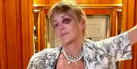 Sharon Stone preocupa fãs ao mostrar olho roxo em férias na Turquia  Foto: Reprodução/Instagram