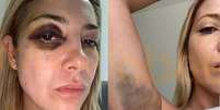 Ex-primeira-dama da Argentina mostra hematomas após agressões de Fernández: 'Você me bate há 3 dias'  Foto: Reprodução/Infobae