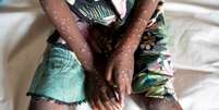 Os surtos de mpox na República Democrática do Congo afetaram tanto crianças como adultos  Foto: Reuters / BBC News Brasil