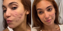 Vanessa Lopes mostra evolução de tratamento da acne. À esquerda, como era antes, e à direita, como ficou depois.  Foto: Reprodução/Instagram