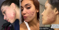Vanessa Lopes, Ana Castela e mais famosas que falam abertamente sobre autoestima e luta contra a acne.  Foto: Reprodu&ccedil;&atilde;o, Instagram / Purepeople