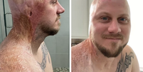 O norte-americano John Pendleton sofreu queimaduras de terceiro e quarto graus em 30% da parte superior do corpo; hoje ele ajuda pessoas a compartilharem suas histórias e lidarem com traumas  Foto: Reprodução/Redes Sociais