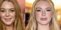 O que Lindsay Lohan fez no rosto? Aparência mais jovem da atriz choca a web e médico explica procedimentos.  Foto: Getty Images / Purepeople