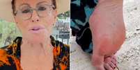 Ana Maria Braga mostrou o pé após ser picada por escorpião  Foto: Reprodução/Instagram 