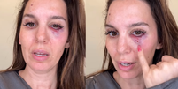 Christy Carlson Romano levou tiros no rosto por engano  Foto: Reprodução