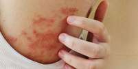 Dermatite at&oacute;pica pode exigir tratamento psicol&oacute;gico  Foto: Shutterstock / Alto Astral