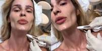 Botox Nefertiti: conheça o procedimento realizado por Yasmin Brunet  Foto: Reprodução / Viva Saúde