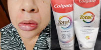 Educadora lábios após uso de creme dental interditado pela Anvisa  Foto: Arquivo pessoal/Denise Correia Santiago