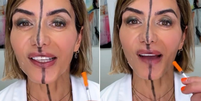 Esteticista americana Bita Farrell aplica botox em apenas um lado do rosto para mostrar efeitos  Foto: Reprodução/Instagram/@drbitaaesthetics - 03.06.2024