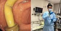 Médico descobre cogumelo crescendo no intestino de paciente Foto: Reprodução