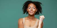 O vitiligo é uma doença autoimune que provoca a descoloração da pele  Foto: Dean Drobot | Shutterstock / Portal EdiCase
