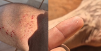Montagem com imagens do local da mordida e do dente da sucuri que ficou preso em Rafael Foto: Reprodução/Instagram/@osglebeiros
