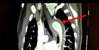 Tomografia feita no tórax da paciente revela o hematoma intramural da aorta torácica  Foto: Reprodução/American Journal of Case Reports