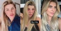 Antes e depois da ex-BBB Íris Stefanellli após lifting facial Foto: Reprodução/Instagram