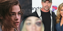 Estrela de '007', Denise Richards exp&otilde;e fotos do rosto ap&oacute;s ser espancada em epis&oacute;dio de paran&oacute;ia do ex-marido: 'Me estrangulava'.  Foto: Getty Images / Purepeople