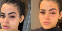 Larissa de Jesus dos Santos pegou infecção após mosca entrar em seu olho  Foto: Reprodução/larissasantosj__/Instagram