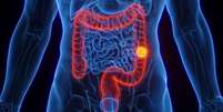 Aumento proporcional de casos de tumor no intestino entre mais jovens chamou a atenção de cientistas  Foto: Getty Images / BBC News Brasil
