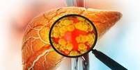 Esteatose hepática: 30% da população brasileira tem gordura no fígado Foto: Shutterstock / Saúde em Dia