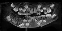 Exame de imagem mostra m&aacute;-forma&ccedil;&atilde;o na denti&ccedil;&atilde;o de garoto com odontoma composto  Foto: Saveetha Dental College and Hospital / Divulga&ccedil;&atilde;o