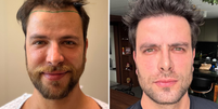 Ex-BBB Gustavo Marsengo mostra resultado 9 meses após ter feito transplante capilar: ‘Um novo homem’  Foto: Reprodução/Instagram
