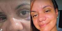 Agredida pelo namorado com 61 socos no elevador de seu prédio, Juliana Soares mostrou o resultado da cirurgia reparadora.  Foto: Reprodução, TikTok / Purepeople