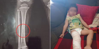 Criança de dois anos quebra perna enquanto estava na escola em Peruíbe  Foto: Reprodução/Rede Social/Estadão Conteúdo
