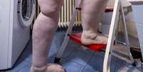 Embora os primeiros relatos da doen&ccedil;a sejam datados dos anos 1940, apenas em 2022 o lipedema passou a ter um c&oacute;digo pr&oacute;prio no Cadastro Internacional de Doen&ccedil;as (CID)  Foto: Picture alliance / Getty Images