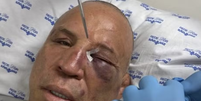 Wanderlei Silva mostrou resultado da luta com Popó  Foto: Reprodução/Instagram/Wanderlei Silva