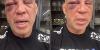 ‘Dois dias e o olho ainda não abriu’, diz Wanderlei Silva  Foto: Reprodução/Instagram