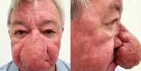 Escoc&ecirc;s com nariz gigante se submete a cirurgia para reparar condi&ccedil;&atilde;o rara  Foto: Reprodu&ccedil;&atilde;o/Ever Clinic