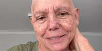 Roseana Sarney conta que assumiu a careca durante o tratamento contra o câncer  Foto: Reprodução/Instagram/@roseanasarney