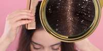 Cabelo com caspa no verão: é verdade que lavar o cabelo todo dia piora a doença? Veja o que dizem especialistas!. Foto: Shutterstock / Purepeople