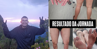 Irmã de jovem que se perdeu em trilha no Pico Paraná divulga imagens das lesões  Foto: Reprodução/@resgaterobertopicoparana/Instagram