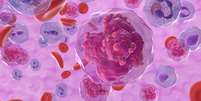 A leucemia &eacute; um c&acirc;ncer das c&eacute;lulas brancas do sangue, os leuc&oacute;citos &ndash; depositphotos.com / forfour  Foto: Giro 10