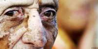 As vítimas de intoxicação por Nemagon na Nicarágua sofreram infertilidade, insuficiência renal crônica, doenças de pele ou câncer  Foto: DW / Deutsche Welle