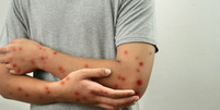 A OMS confirmou nesta semana dois casos de Mpox, no Reino Unido e na Índia, em que indivíduos foram infectados por uma cepa recombinante Foto: Getty Images Signature/airdone / Bons Fluidos