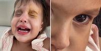 Menina de 2 anos tem corte na c&oacute;rnea durante brincadeira Foto: Reprodu&ccedil;&atilde;o/Instagram