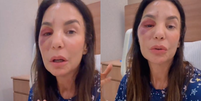 Ivete Sangalo com o rosto inchado após cirurgia  Foto: Reprodução/Instagram