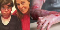 O que é epidermólise bolhosa, condição que vitimou neto de coreógrafa aos 14 anos  Foto: Reprodução/@deborahcolker/Instagram | Reprodução/DEBRA UK