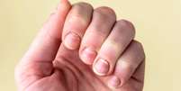 Manchinhas brancas nas unhas? Na maioria das vezes, não é falta de cálcio -depositphotos.com / natali_ploskaya  Foto: Giro 10
