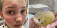 Menina sofre queimaduras ap&oacute;s fazer trend do TikTok  Foto: Reprodu&ccedil;&atilde;o/Facebook/The Hartcliffe Dingles