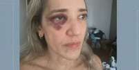 Ana Cristina Dur&atilde;o Nunes foi agredida por motociclista de aplicativo   Foto: Reprodu&ccedil;&atilde;o/TV Globo