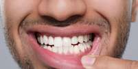 Boca seca, gengivas inflamadas e perda dent&aacute;ria podem ser sinais iniciais de diabetes  Foto: Shutterstock / Sa&uacute;de em Dia