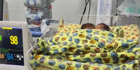 Bebês siameses nasceram em maio, em Goiânia   Foto: Reprodução/Instagram/Dr. Zacharias Calil