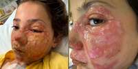 Violet Zerbst, de 10 anos, passou uma semana em um hospital de Gold Coast depois de aquecer um brinquedo mole em um microondas antes de apertá-lo Foto: Reprodução/7News