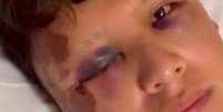 O turista mexicano Kevin Jonoel teve graves hematomas nos olhos e em todo o rosto.  Foto: Reprodução/ Redes Sociais